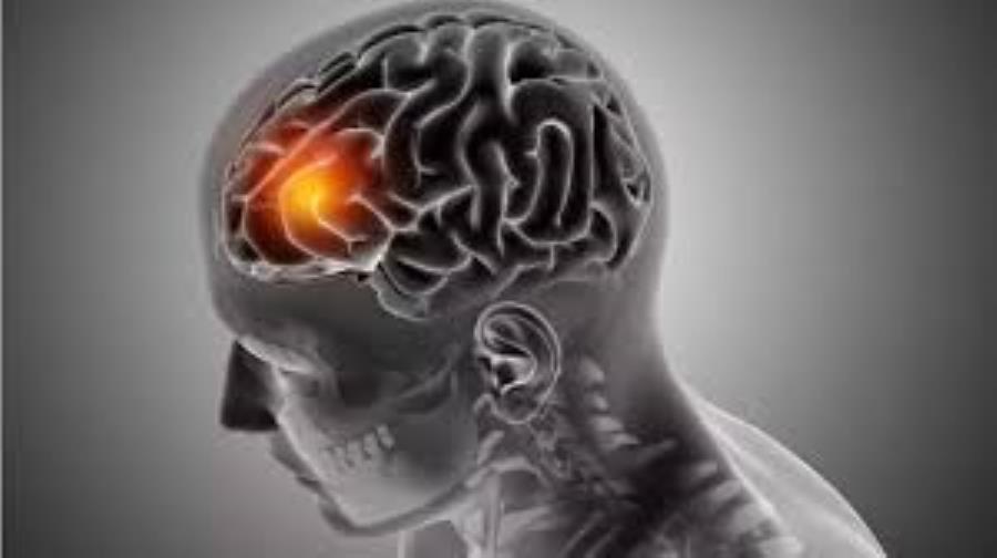 تست جدید نوع تومور مغزی را دو ساعته تشخیص می دهد
